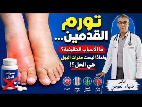 الدكتور ضياء العوضي | تورم القدمين... ما الأسباب الحقيقية؟ ولماذا ليست مدرات البول هي الحل؟
