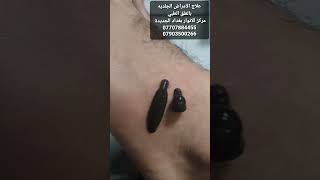 علاج الامراض الجلديه  بالعلق الطبي مركز الانوار بغداد الجديدة 0707884455/07903500266