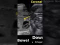 Fetal echogenic bowel doctor ultrasoundtechnologist informational ultrasoundtech