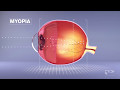 EyeDream Advanced Ortho-k - What is Ortho k?
