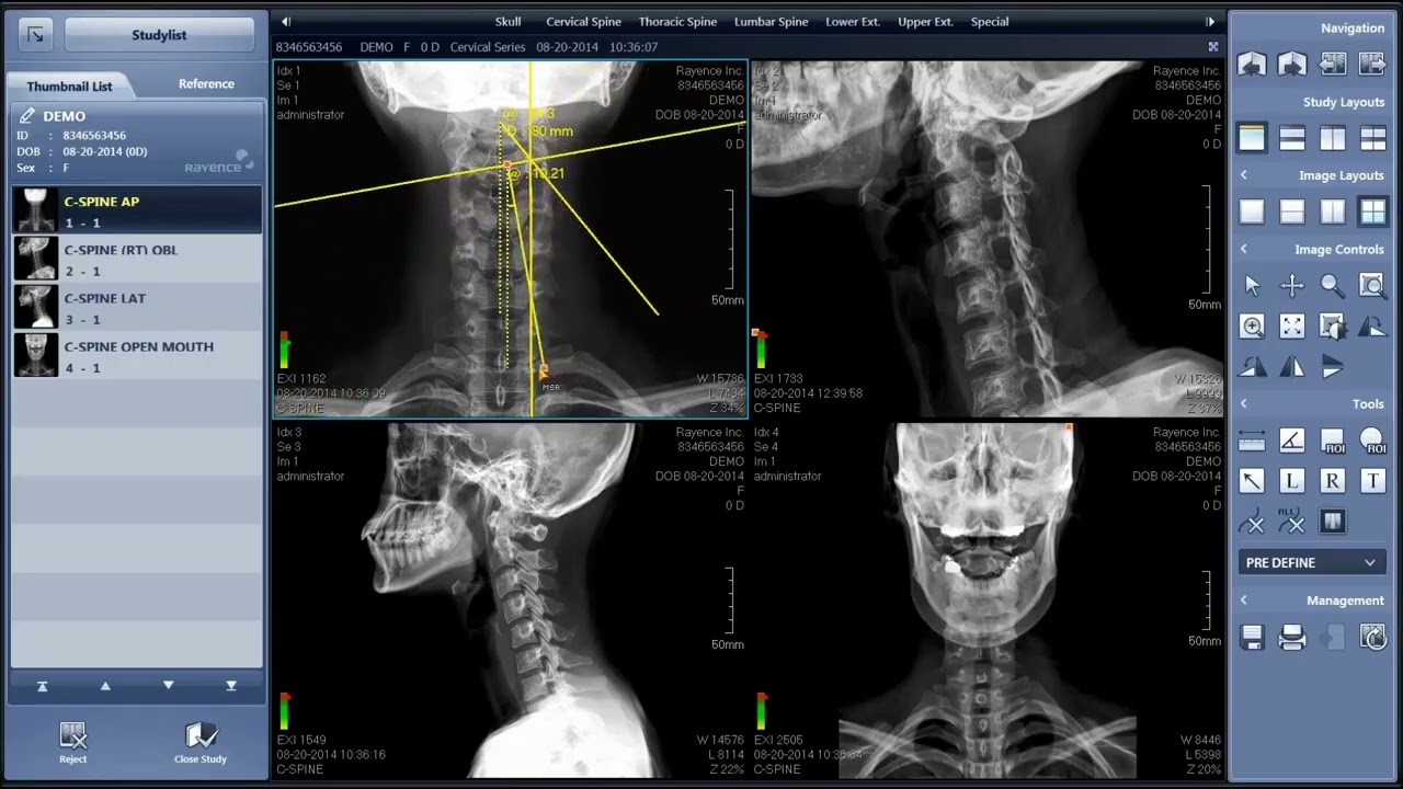 Xmaru Chiropractic Viewer | Rayence Digital X-Ray Software for Chiropractors