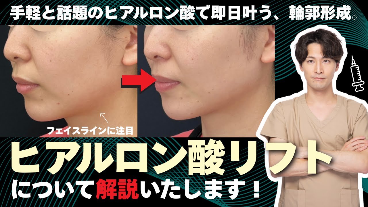 【ヒアルロン酸でリフトアップ】ヒアルロン酸リフトとは？即日アプデ可能♪イベント前にやる人続出中！