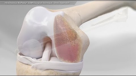 IntraOsseous BioPlasty® (IOBP) Surgical Technique - Direct Approach
