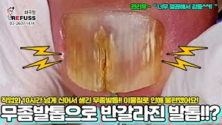 무좀으로 인해 반으로 갈라진 발톱!?? 작업화만 10시간 신어 생긴 무좀발톱 케어합니다^^ #레푸스 #refuss #무좀발톱 #내성발톱 #발톱 #발톱무좀 #toenails