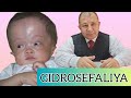 GIDROSEFALIYA  MIYYA 80% YO&#39;Q // 2-YARIM YILLIK NATIJA//Dr.JALILOV