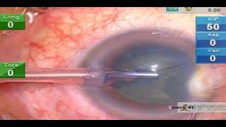DMD: a complication in cataract surgery  - Supplementary video  [ID 283770]