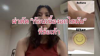 แชร์ประสบการณ์ ผ่าตัดก้อนเนื้องอกไขมัน (Lipoma) เป็นแผลเป็น?