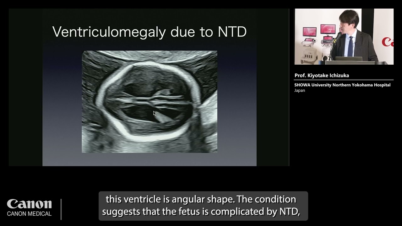 ISUOG 2023 – Prof. Kiyotake Ichizuka - 2nd trimester anomaly scan using the new Technology