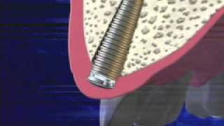 Dental implants castle hill implant dentist for missing tooth or teeth.flv
