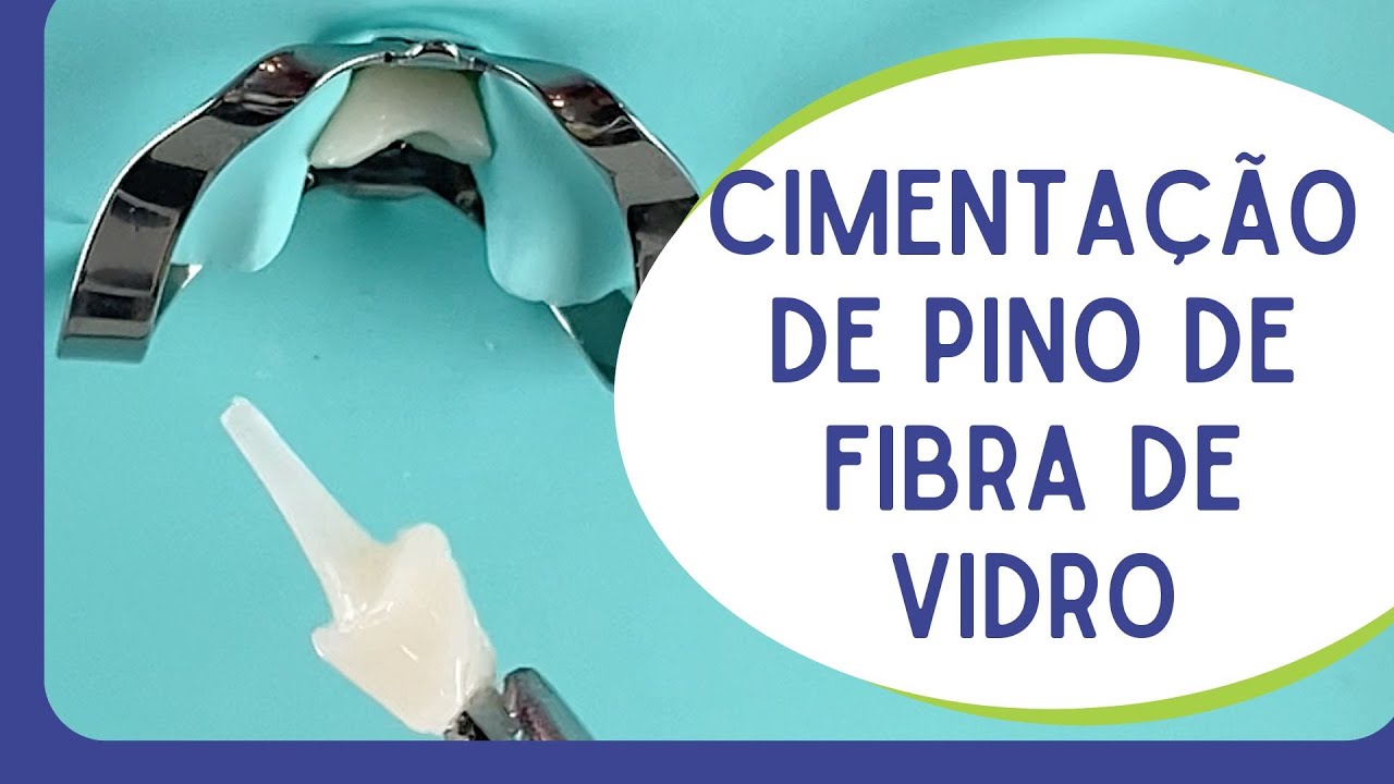 Cimentação de pino de fibra de vidro