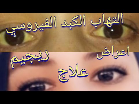 التهاب الكبد الفيروسي،اليرقان ،الصفاير ،اعراض ،علاج،