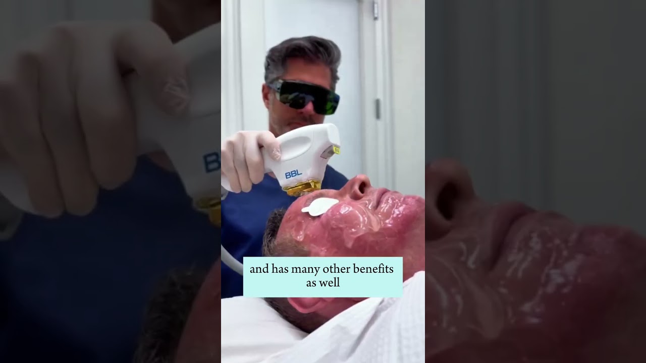 How BBL Laser Reduces Rosacea & Redness