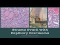 Struma Ovarii with Papillary Thyroid Carcinoma