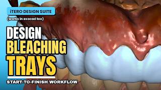 How to Design Bleaching Trays in iTero Design Suite/ Exocad (Full Step-by-Step Tutorial)
