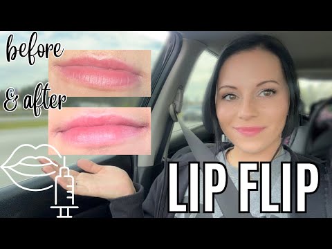 I GOT A LIP FLIP | before & after + my experiece