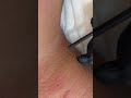 Extirpación Queratomas Verrugas Papilomas Lunares Удаление Кератом Бородавок Папиллом Родинок Липом