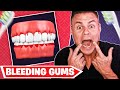 Bleeding gums?! What they mean and how to treat them! *Surprising!*