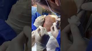 شاهد كيف تتم عملية زراعة الشعر في Change me clinic #shorts