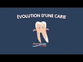 Evolution dune carie