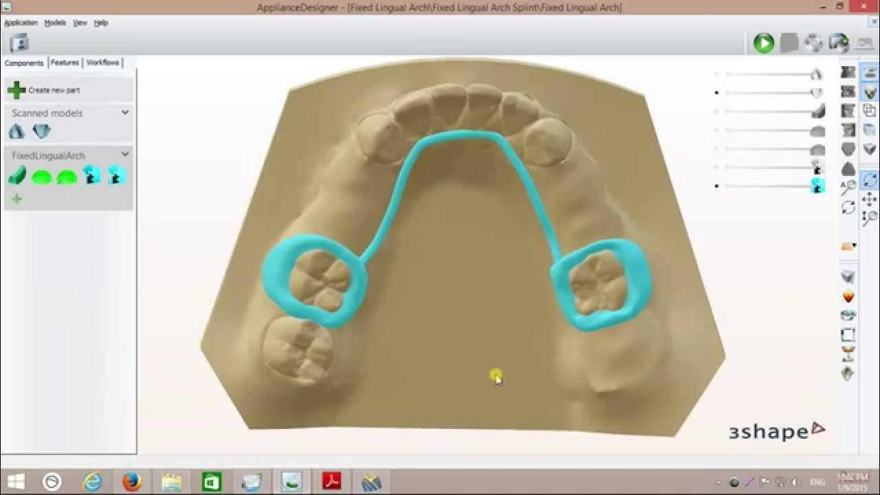 Fixed Lingual Arch Appliance Design YouTube