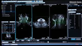 MRI CERVICAL SPINE  الرنين المغناطيسي علي الفقرات العنقية