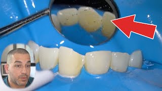 How the Dentist Repairs a Chipped Tooth | Under the Dental Microscope
