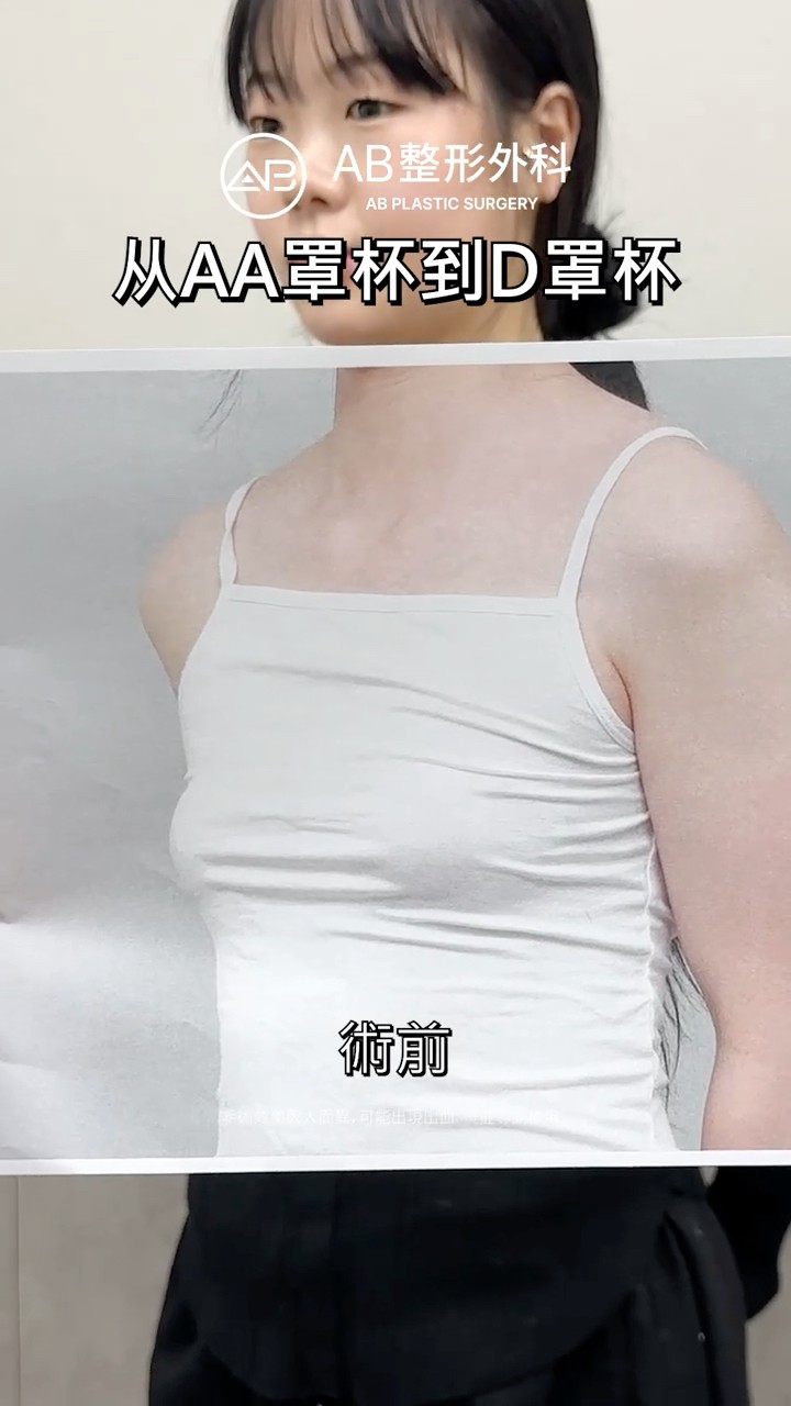 隆胸(假体)，讓身材曲線更有層次🤍 #Shorts