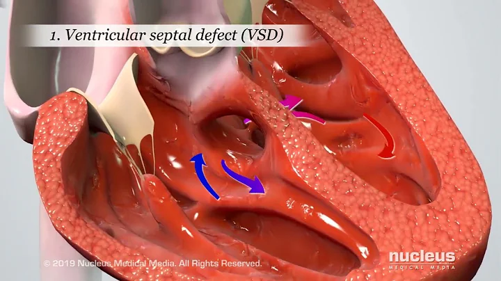 Blue Baby Heart Defect: Tetralogy of Fallot