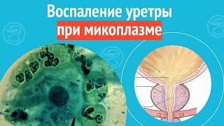 👉 Воспаление уретры при микоплазме. Клинический случай №1261