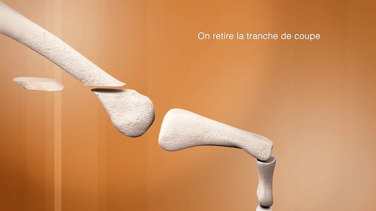 Chirurgie Du Pied Clinique Du Parc Caen