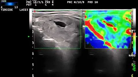 Che cos'è l adenoma di Plummer?