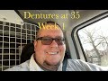 Week 1 with immediate dentures after 24 teeth extracted. Dentures at 35