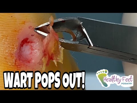 WART POPS OUT OF FOOT!  AMAZING WART REMOVAL!