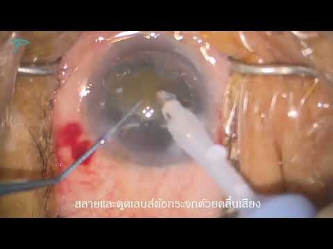 การผ่าตัดต้อกระจก เปลี่ยนเลนส์แก้วตาเทียม