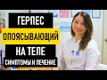 Опоясывающий герпес: симптомы и лечение у взрослых. Чем и как лечить опоясывающий герпес на теле