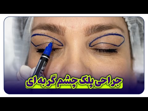 جراحی زیبایی پلک بلفاروپلاستی پلک بالا