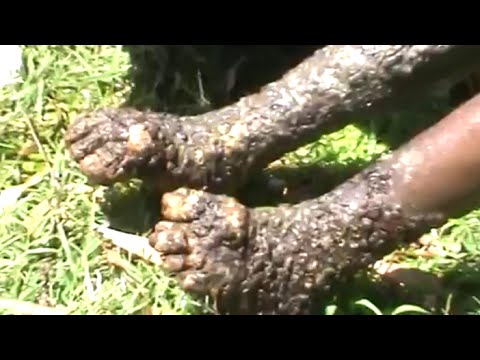 スナノミ症の動画 画像 動画検索 マイルドサイト