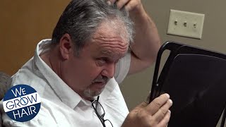 Does a Hair Transplant Really Work?