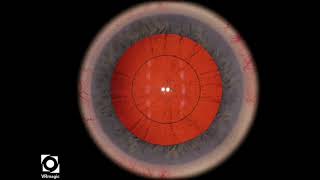 EyeSi CAT D Capsulorhexis Errant Tear CCW, Medium Tension Net Worth