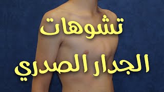 تشوهات الصدر: الأنواع والعلاج