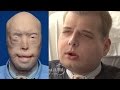 SEVERELY BURNED FIREFIGHTER GETS A FACE TRANSPLANT