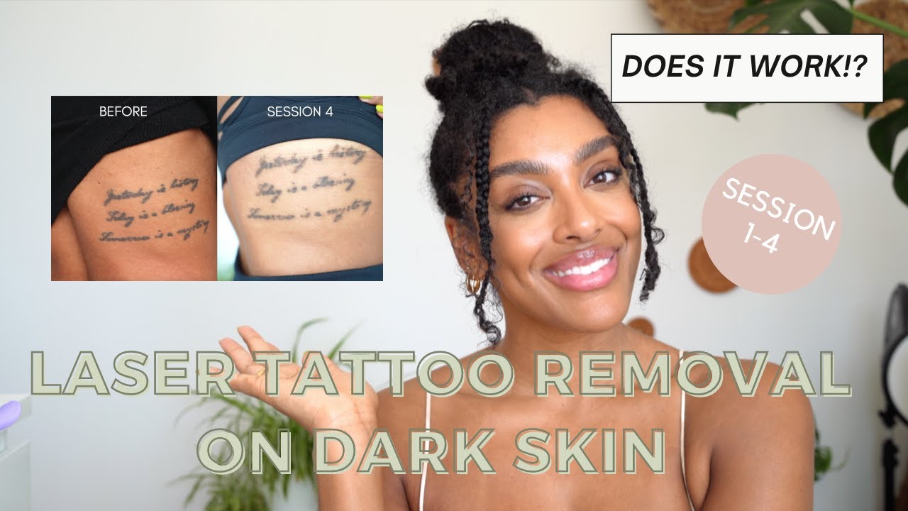 LASER TATTOO REMOVAL ON DARKER SKIN || SESSION 1-4 EXPERIENCE AND RESULTS -  YouTube