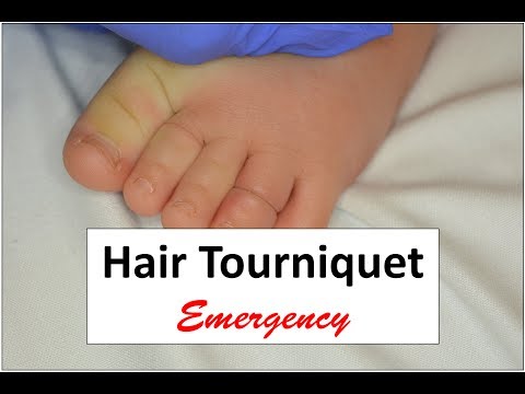 Video: Hair Tourniquet: Far Advarer Mot Hår Som Avskåret Babyens Sirkulasjon