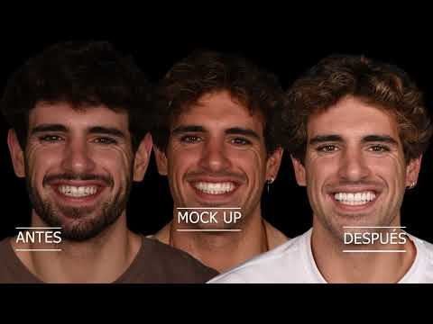 Andreu Martorell nos habla sobre su diseño de sonrisa con carillas dentales by Dr. Ferran Llansana