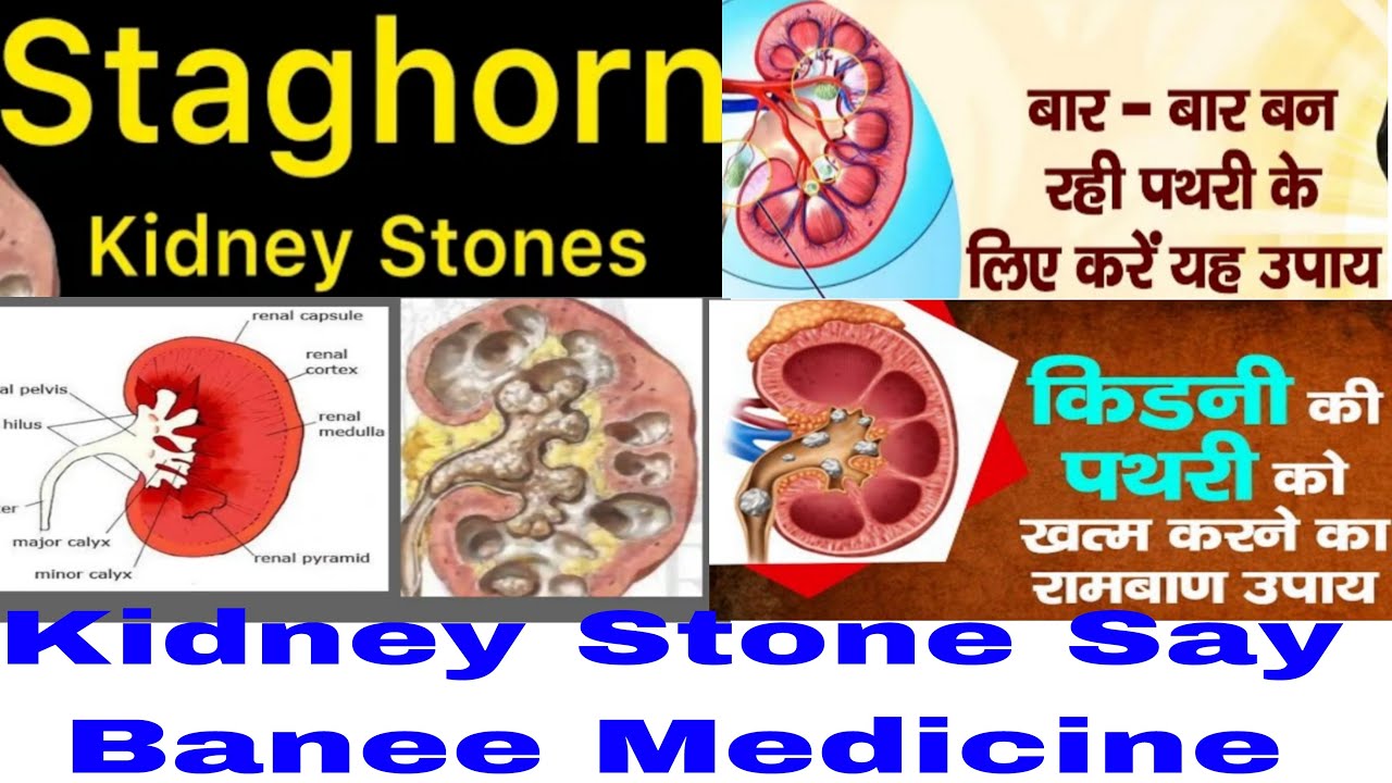 Staghorn Kidney Stone Kya Hota Hai Repeated Formation OF Kidney Stone staghorn-kidney-stone-kya-hota-hai-repeated-formation-of-kidney-stone