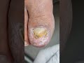 발톱을 자르고 싶어요 / Thick Toenail Scaling