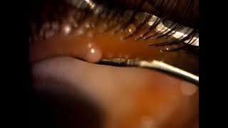 Eyelid squeezing - popping a stye
