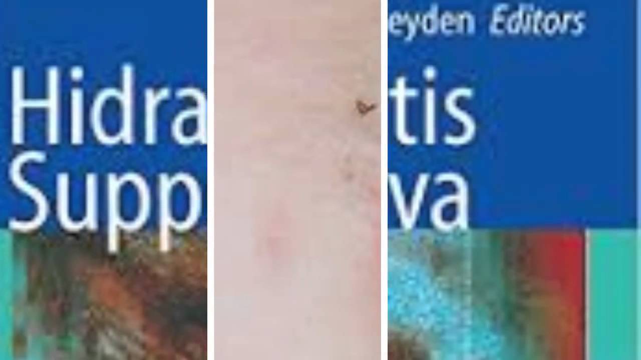 Hidradenitis Suppurativa Home Remedies YouTube