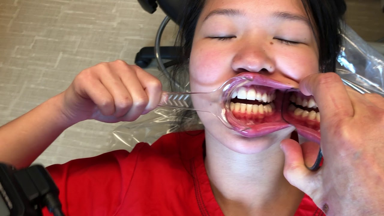Intraoral photo 101 Facial to side view YouTube