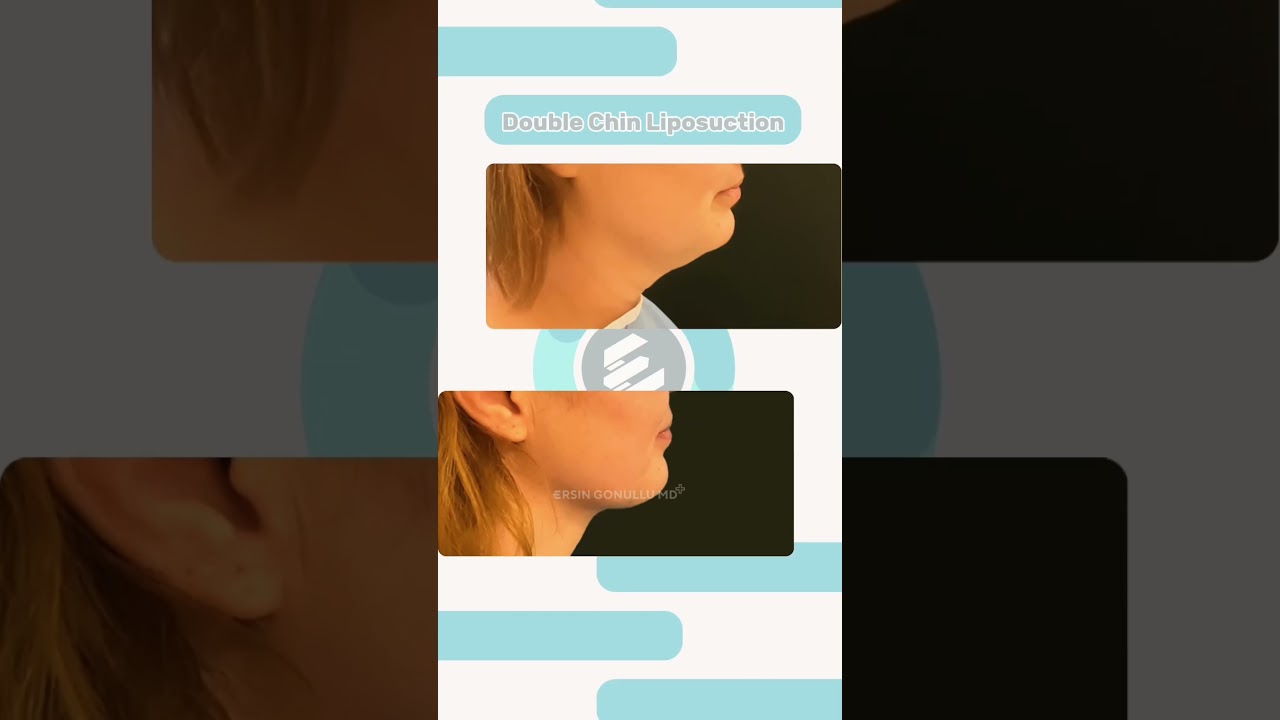 Double Chin Liposuction | J Plasma | Renuvion | Plastic Surgery | Istanbul |Turkey |